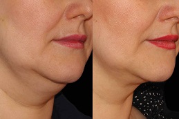 Best Double Chin Removal Clinic in Islamabad