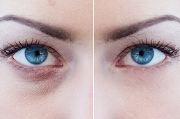 Best Eye Bag Removal Clinic in Islamabad