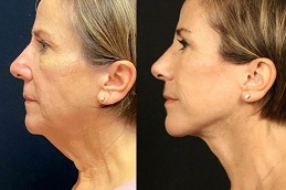 Best Fractional co2 Laser Treatment in Islamabad (1)