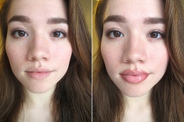 Best Lip Fillers Injection in Islamabad