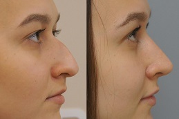 Best Liquid Rhinoplasty Clinic in islamabad