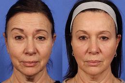 Best Masseter Botox Clinic in Islamabad