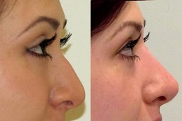 Best Rhinoplasty Clinic in Islamabad