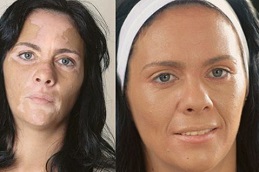 Best Vitiligo Treatment Clinic in Islamabad