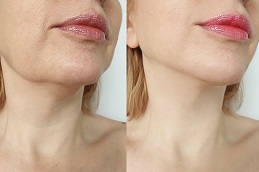 Double Chin Removal Clinic in Islamabad