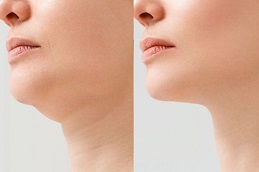 Double Chin Removal in Islamabad