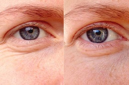 Eye Bag Removal Clinic in Islamabad