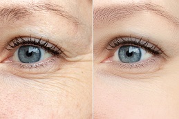 Eye Bag Removal in Islamabad
