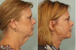 Fractional co2 Laser Treatment Clinic in Islamabad