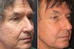Fractional co2 Laser Treatment in Islamabad