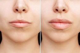 Lip Fillers Injection Clinic in Islamabad