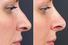 Liquid Rhinoplasty Clinic in islamabad