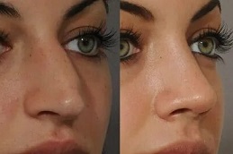 Liquid Rhinoplasty in islamabad