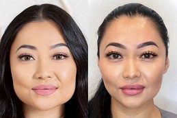Masseter Botox Clinic in Islamabad