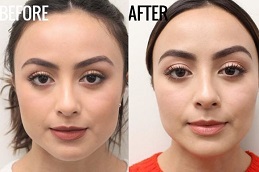 Masseter Botox in Islamabad