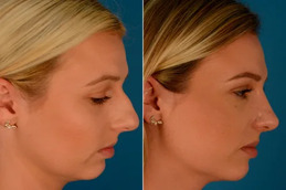 Rhinoplasty Clinic in Islamabad