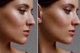 Rhinoplasty in Islamabad
