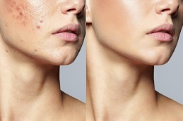 Skincare Treatment in Islamabad