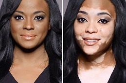 Vitiligo Treatment Clinic in Islamabad