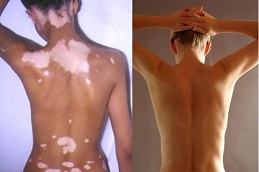 Vitiligo Treatment in Islamabad