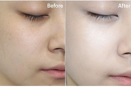 glutathione injections Clinic in Islamabad