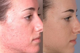 Acne Scars Treatment Clinic in Islamabad