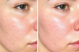 Acne Scars Treatment in Islamabad
