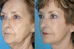Anti-Aging Treatments Clinic in Islamabad