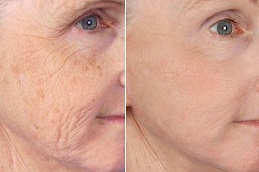 Anti-Aging Treatments in Islamabad
