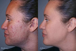 Best Acne Scars Treatment in Islamabad
