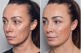 Best Anti-Aging Treatments in Islamabad