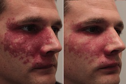 Best Birthmark Removal in Islamabad
