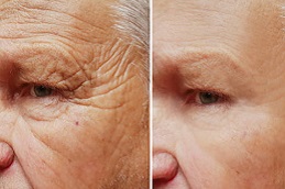 Best  Botox Injections in Islamabad