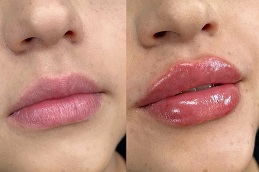 Best Botox Lip Flip Clinic in Islamabad
