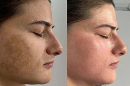 Best Chemical peels Clinic in Islamabad