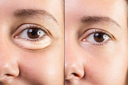 Best Dark Circles Treatment in Islamabad
