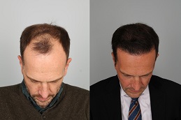 Best FUE Hair Transplant in Islamabad