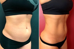 Best Fat Reduction Treatment in Islamabad