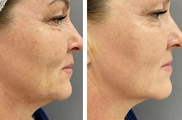Best HIFU Treatment in Islamabad