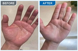 Best Hyperhidrosis Treatment in Islamabad
