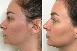 Best Jawline Fillers in Islamabad