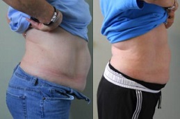 Best Laser Liposuction in Islamabad