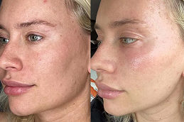 Best Laser Skin Tightening in Islamabad