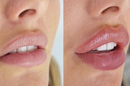 Best Lip Tinting in Islamabad