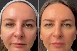 Best Mesotherapy Treatment in Islamabad
