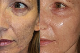 Best Microneedling Treatment in Islamabad
