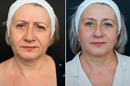 Best PDO thread lift Clinic in Islamabad