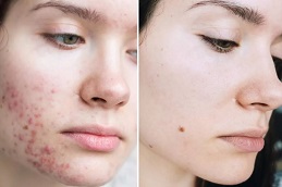 Best  Pigmentation Treatmentin Islamabad
