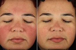 Best Rosacea Treatment in Islamabad