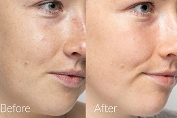 Best Sculptra Fillers in Islamabad